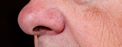 Rhinophyma